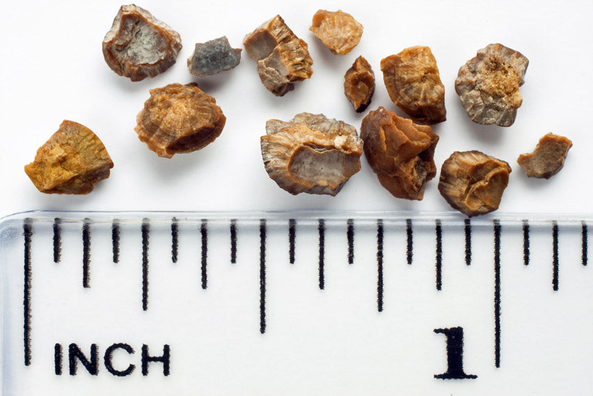 The four types of kidney stones (and how to limit them)